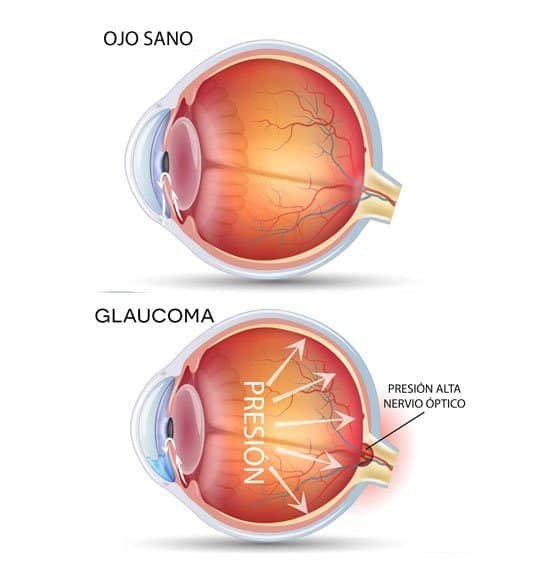 Glaucoma